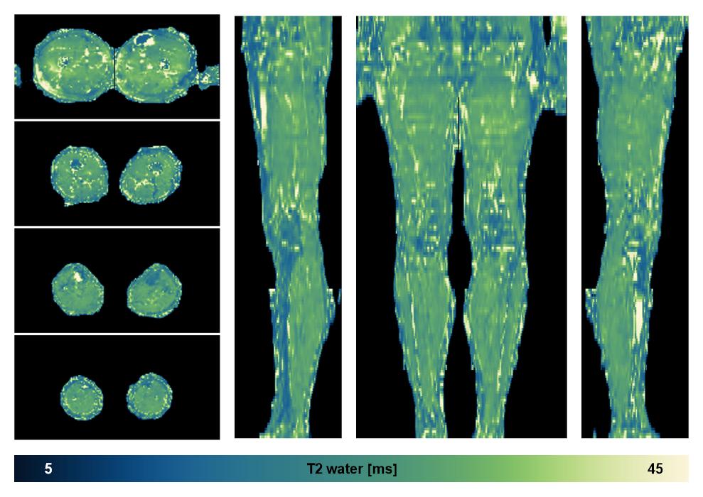 The water only T2 relaxation time of the lower extremity obtained from multi echo spin echo t2 mapping with EPG based reconstruction.